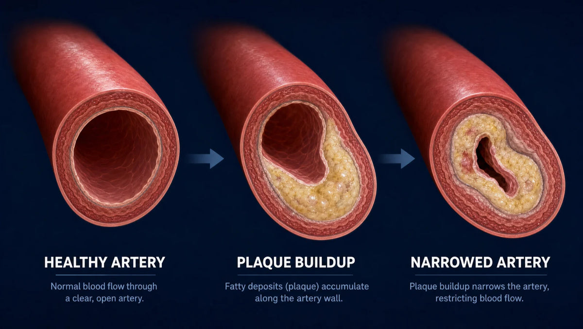 Three-stage illustration: healthy artery, plaque buildup, narrowed artery.